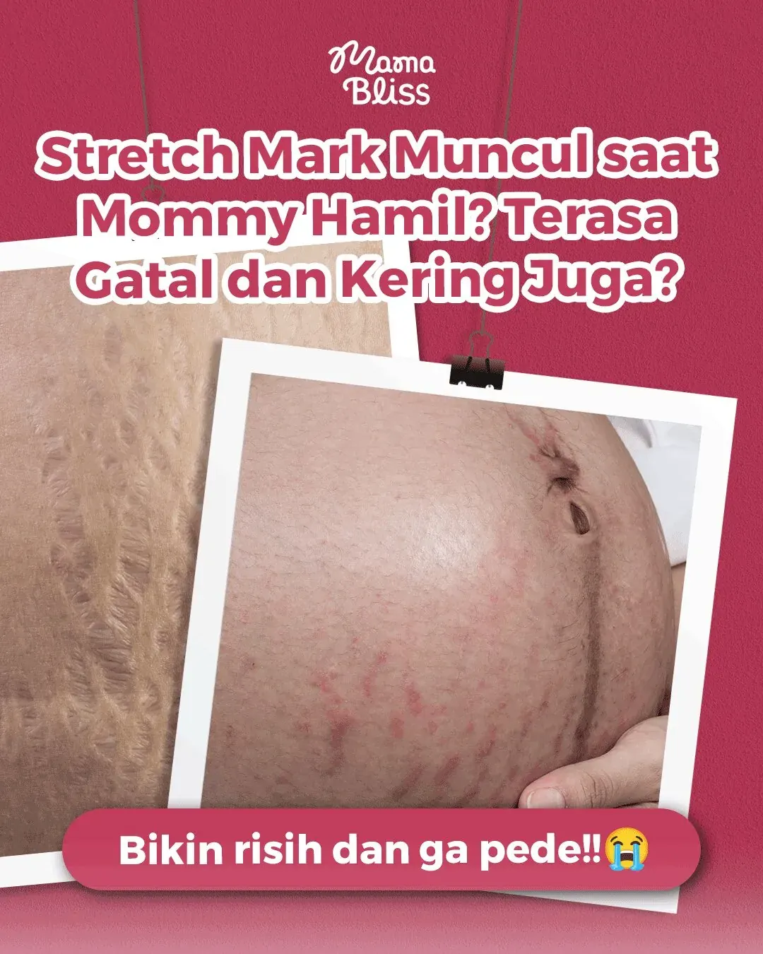 Stretch mark muncul saat Mommy hamil? Terasa gatal dan kering juga?